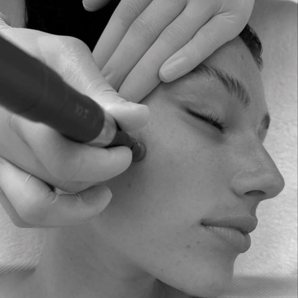 A Holistic Approach to Microdermabrasion